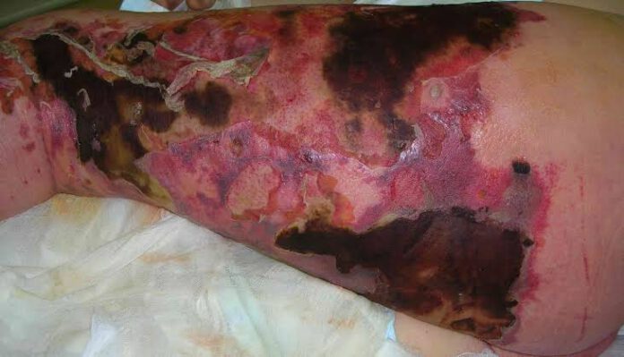 Flesh eating Bacteria